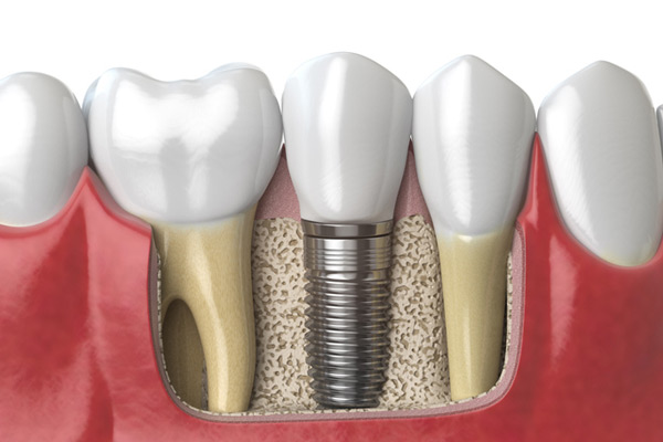 3D rendering of a dental implant next to healthy teeth